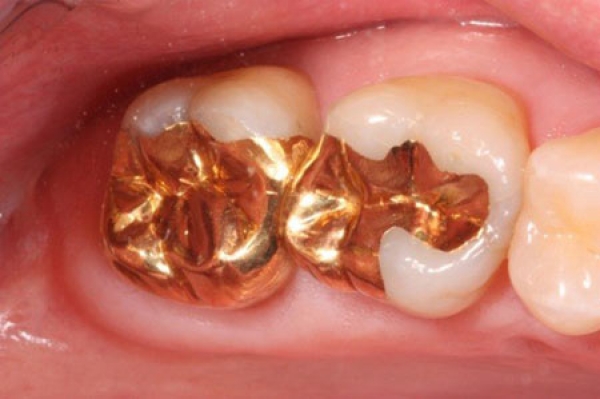 آشنایی با انواع مواد مختلف پر کردن دندان