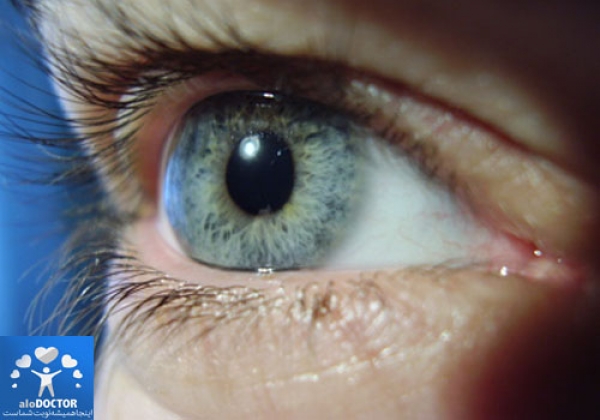 لیزردرمانی یا حرارت درمانی روشهایی برای درمان بیماری ملانوم چشم