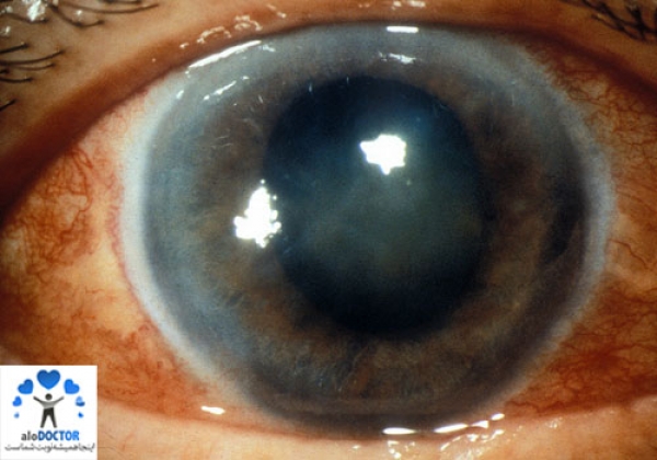جراحی با لیزر روش نهایی برای درمان آب‌ سیاه چشم