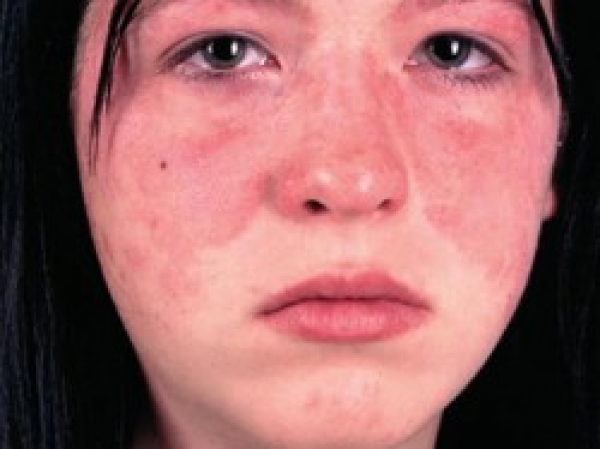 بیماری لوپوس چیست و چگونه درمان می شود؟