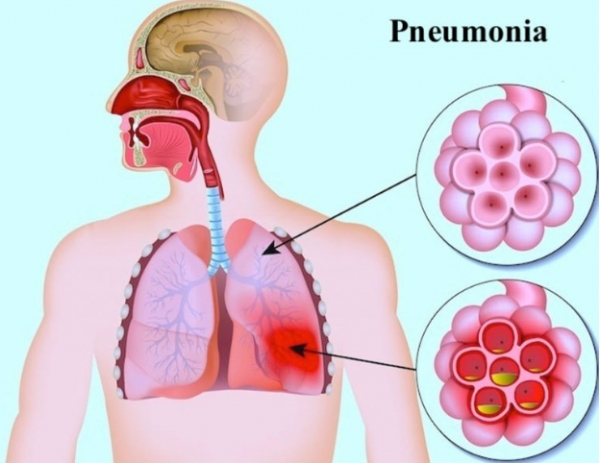 پنومونی، عفونت ریه یا ذات الریه چیست؟