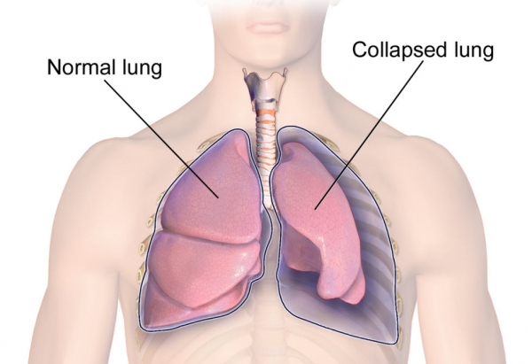  پنوموتوراکس ریه چیست و چه مشکلاتی ایجاد می‌کند؟