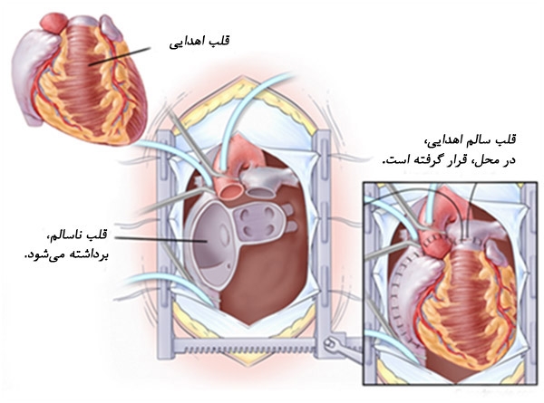 همه چیز درباره عمل جراحی پیوند قلب