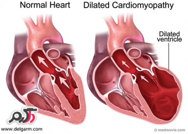 هایپرتروفی یا ضخیم شدن عضله قلب