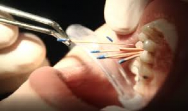 پرسش های متدوال درباره عصب کشی و درمان ریشه دندان؟