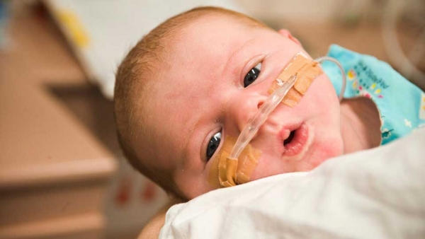 سندرم دیسترس تنفسی نوزادان چیست؟